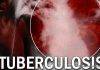 TB remains a burden – Find, Treat, Cure TB