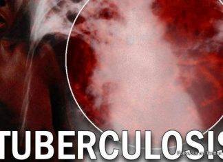 CPS on World TB Day: Unite to End Tuberculosis
