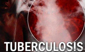 TB remains a burden – Find, Treat, Cure TB