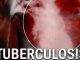 TB remains a burden – Find, Treat, Cure TB