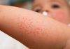 CPS puts Local Physicians on Alert for Rash and Fever in Patients