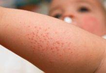 CPS puts Local Physicians on Alert for Rash and Fever in Patients