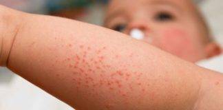 CPS puts Local Physicians on Alert for Rash and Fever in Patients