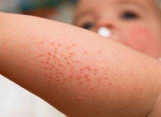 CPS puts Local Physicians on Alert for Rash and Fever in Patients