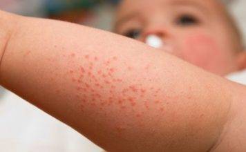 CPS puts Local Physicians on Alert for Rash and Fever in Patients