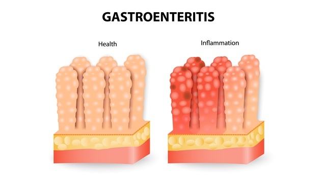 Gastroenteritis