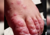 CPS advises community to take preventive measures to prevent Hand Foot and Mouth Disease