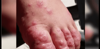 CPS advises community to take preventive measures to prevent Hand Foot and Mouth Disease