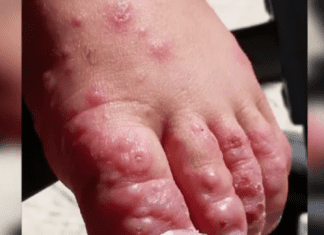 CPS Urges Parents and Guardians to be on alert to prevent Hand Foot and Mouth Disease