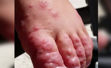 CPS Urges Parents and Guardians to be on alert to prevent Hand Foot and Mouth Disease