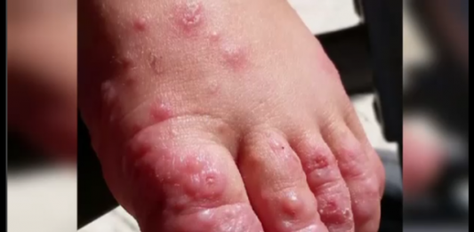 CPS Urges Parents and Guardians to be on alert to prevent Hand Foot and Mouth Disease