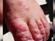 CPS Urges Parents and Guardians to be on alert to prevent Hand Foot and Mouth Disease