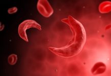 SMMC teams up with SSCF on World Sickle Cell Day