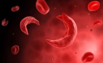 SMMC teams up with SSCF on World Sickle Cell Day