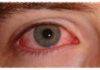 CARPHA urges communities to take action on preventing ‘red/pink eye’