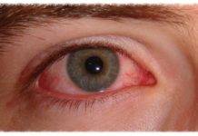 CARPHA urges communities to take action on preventing ‘red/pink eye’