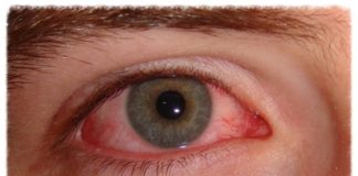 CARPHA urges communities to take action on preventing ‘red/pink eye’