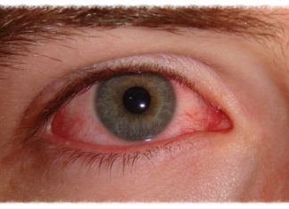 CARPHA urges communities to take action on preventing ‘red/pink eye’
