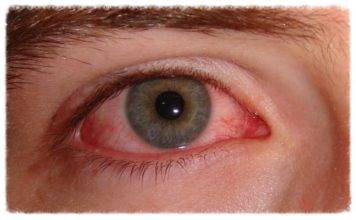 CARPHA urges communities to take action on preventing ‘red/pink eye’