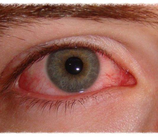 CARPHA urges communities to take action on preventing ‘red/pink eye’