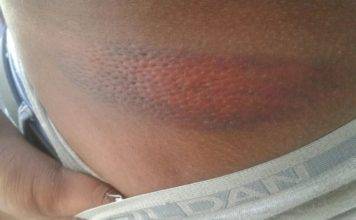 Joven dominicano denunció fue agredido brutalmente por agentes policiales