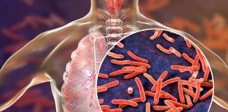 TB is preventable and curable. Avoid spreading TB to others