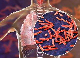TB is preventable and curable. Avoid spreading TB to others