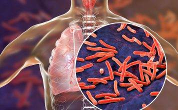 TB is preventable and curable. Avoid spreading TB to others