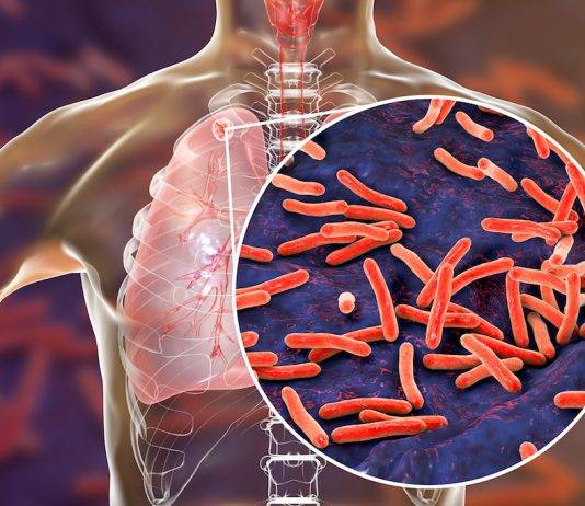 TB is preventable and curable. Avoid spreading TB to others