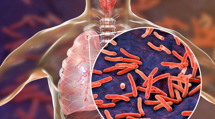 TB is preventable and curable. Avoid spreading TB to others