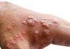 First case of Monkeypox has been identified on French, Saint Martin