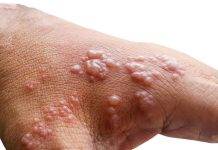 KASO PROBABEL DI MONKEYPOX NA KÒRSOU