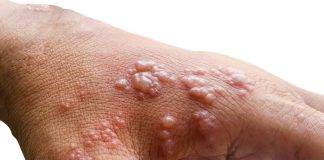 KASO PROBABEL DI MONKEYPOX NA KÒRSOU