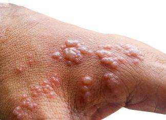 First case of Monkeypox has been identified on French, Saint Martin
