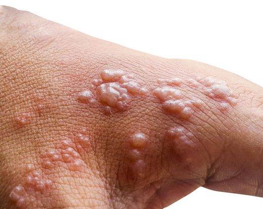 First case of Monkeypox has been identified on French, Saint Martin