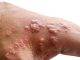 KASO PROBABEL DI MONKEYPOX NA KÒRSOU