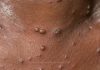 CPS calls on community to take preventive measures to prevent chickenpox