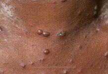 CPS calls on community to take preventive measures to prevent chickenpox