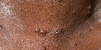 CPS calls on community to take preventive measures to prevent chickenpox