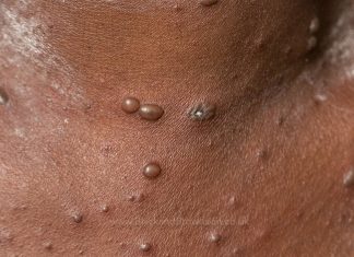 CPS calls on community to take preventive measures to prevent chickenpox