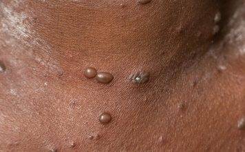 CPS calls on community to take preventive measures to prevent chickenpox